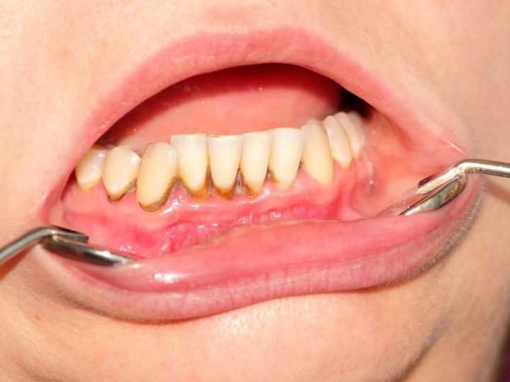 牙菌斑检测实验报告 牙菌斑的检测方法